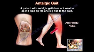 Painful Gait Antalgic Gait  Everything You Need To Know  Dr Nabil Ebraheim [upl. by Anytsirhc]