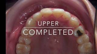 DSD in Traditional Orthodontics [upl. by Brunhild]