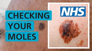 How do I check if my mole is skin cancer  NHS [upl. by Onimixam]