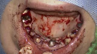 241111 Straumann BLT NC placement in aiterior maxilla 5 [upl. by Akeryt]