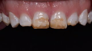 Fixing Brown Chipped TeethCosmetic Dentistry [upl. by Mariam984]