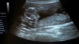 Ultraschall in der 15 SSW Its a Boy [upl. by Ahsatniuq]