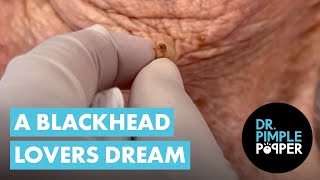 A Blackhead Lovers Dream [upl. by Rodger]