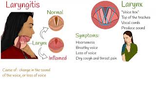 Laryngitis  Symptoms causes and treatment [upl. by Kathye]