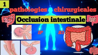 cours S3  Pathologies Chirurgicales et SI  Occlusion Intestinale Aiguë 1 OIA🩺🎯📚شرح سهل و مبسط 📚 [upl. by Nimesay]