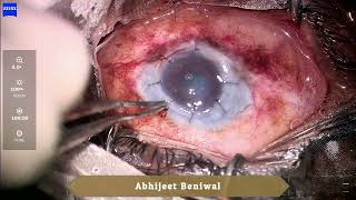 Optical penetrating keratoplasty in Xeroderma Pigmentosum [upl. by Alebasi]