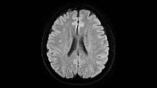 Neuroradiology Acute Bilateral Fornix Infarction from radiopedia case radiology neuroradiology [upl. by Attirb]