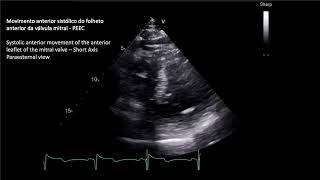 MIOCARDIOPATIA HIPERTROFICA OBSTRUTIVA  OBSTRUCTIVE HYPERTROPHIC MYOCARDIOPATHY [upl. by Iridissa]