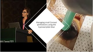 Cyanoacrylate glue  to manage small Corneal Perforations An Instructional Video [upl. by Kev]