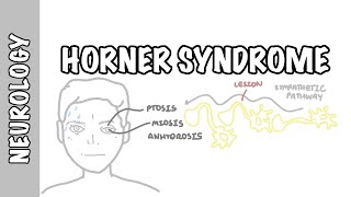 Horner Syndrome  anatomy causes pathophysiology investigation [upl. by Gusella]