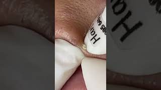 blackheads removal frim the lips [upl. by Rozele284]