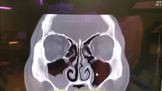 鼻竇炎 電腦斷層掃描 CT of rhinosinusitis [upl. by Vitus]