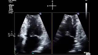 Abnormal Echo Trileaflet Mitral Valve And Hypertrophic Cardiomyopathy With 3D Echo Images [upl. by Aleunamme]