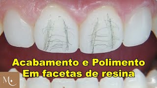 Acabamento e Polimento em facetas de resina [upl. by Liggitt]