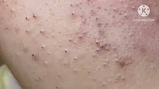 Super blackheads HoangMySpa24 [upl. by Hatokad890]