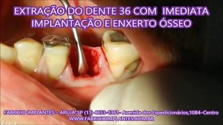 EXTRAÇÃO DO DENTE 36 COM IMEDIATA IMPLANTAÇÃO E ENXERTO ÓSSEO [upl. by Octavus]