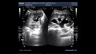 Ultrasound Video showing renal hydronephrosis with hydroureter due to multiple vesical masses [upl. by Annwahsal313]