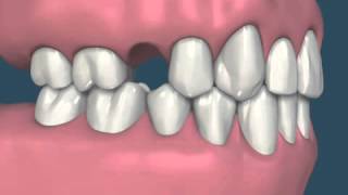 Migração dentária causada pela perda de um dente  Guilherme Claudino Odontologia [upl. by Stedmann]