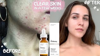 The Ordinary skincare CLEARED MY FACE for good ACNE OUT skincare update [upl. by Eanert]