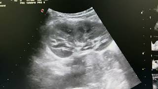 Mild loss of corticomedullary differentiation with mild echogenic parenchyma in 5 yr boy [upl. by Hotchkiss17]