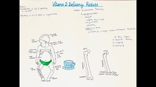 Rickets Vitamin D deficiency in children Bone manifestation signs and symptoms High yield info [upl. by Essyla]