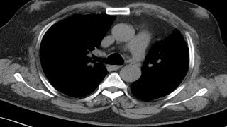 Cross sectional and imaging anatomy of the thorax [upl. by Ahseki]