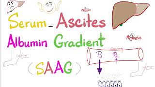 Serum Ascites Albumin Gradient SAAG  Peritoneal Effusion  Lab 🧪 [upl. by Kendal]