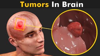 How Tumors Are Formed Inside The Brain  Glioma Brain Tumors 3D Animation [upl. by Cleavland]