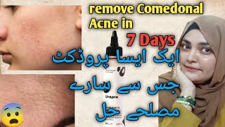 How To Remove Comedonal Acne At Home  Comedonal Acne Treatment in Hindi Urdu [upl. by Botti]