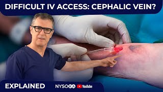 Difficult IV access Cephalic Vein [upl. by Yseulte]