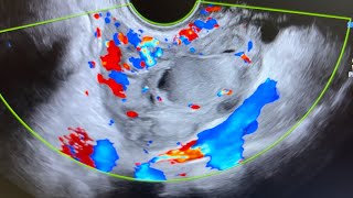 Ultrasound of acute salpingitis thick vascular fallop tube endometriotic simple amp nabothian cyst [upl. by Noj481]