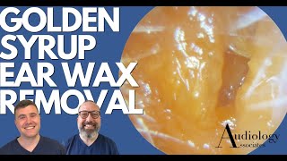 GOLDEN SYRUP EAR WAX REMOVAL  EP888 [upl. by Anelec]