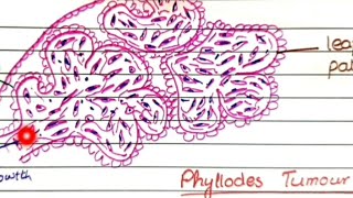 Fibroadenoma And Phyllodes Tumor  Pathology [upl. by Lucius71]