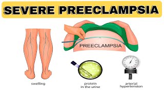 Severe Preeclampsia  NCLEX REVIEW [upl. by Atthia532]