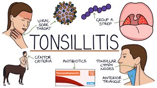 Understanding Tonsillitis [upl. by Fry]