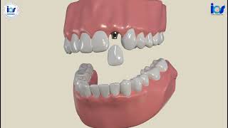 Treatment options for Missing Lateral incisor [upl. by Casta]