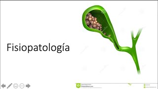 Fisiopatología de colelitiasis [upl. by Rosecan]