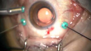 Vitrectomy primary procedure for repair of retinal detachment among Europeans [upl. by Myrle]