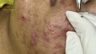 Loan Nguyen Acne Treatment 17744 [upl. by Sitoel]