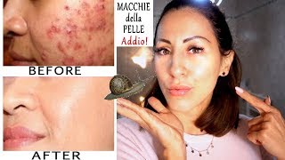 ELIMINARE MACCHIE DAL VISO ACNE  SEGNI  BRUFOLI  IMPERFEZIONI Addio per sempre  Carlitadolce [upl. by Myrtice]