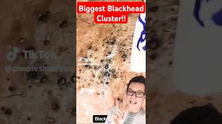 Crazy BLACKHEAD CLUSTER  Blackheads removal shorts [upl. by Chae110]