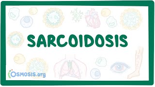 Sarcoidosis  causes symptoms diagnosis treatment pathology [upl. by Ailes]