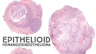 Epithelioid hemangioendothelioma EHE Australasian Dermpath 2022  Case 9 pathology dermatology [upl. by Elata]