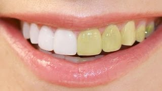 Photoshop Tutorial  How to Make Whitening Teeth [upl. by Roderich794]