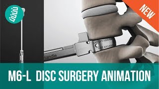 M6L Artificial Disc Replacement ADR Surgery Animation [upl. by Neelrihs154]