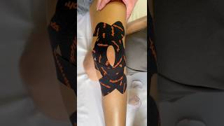 Choose the effective way and stabilize the patella like José  Professional Sports Physio [upl. by Mireielle240]