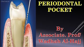 14 Periodontal diseases 4 Periodontal pockets  Dr Wadhah Periodontology lectures د وضاح الحاج [upl. by Sauer626]