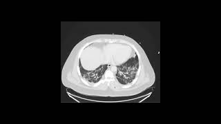 Abdominal Case Conference  152021 [upl. by Robma253]