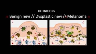 Introduction to Skin Cancer 3 Overview of Nevi and Melanoma [upl. by Rafaela]