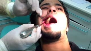 Third molar Extraction wisdom tooth [upl. by Valma]